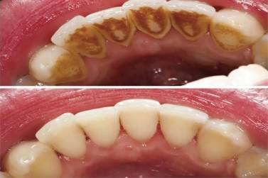 Teeth Cleaning (Scaling and Polishing)