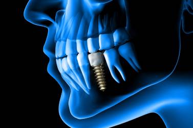 Dental Implant